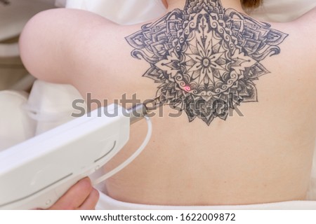 Top view hand of a beautician holds a laser device over a tattooed back of a girl to remove an unwanted tattoo. Concept of erasing tattoos as expensive procedure in beauty parlor modern vedical clinic Royalty-Free Stock Photo #1622009872