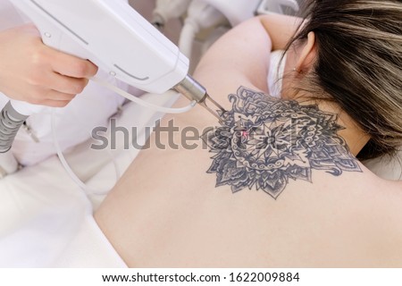 Top view hand of a beautician holds a laser device over a tattooed back of a girl to remove an unwanted tattoo. Concept of erasing tattoos as expensive procedure in beauty parlor modern vedical clinic Royalty-Free Stock Photo #1622009884