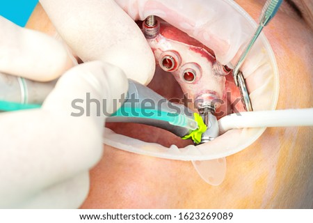 Close up of digital guided implant surgery on patient - new implant technology in dentistry - Selective focus Royalty-Free Stock Photo #1623269089