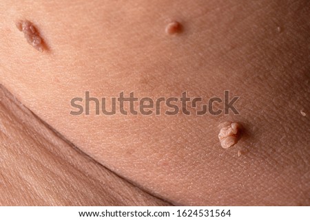 Skin tag or acrochordon or soft fibroma or mole in male armpit, macro photo. Papilloma virus or bump, dermatology problem on skin concept.