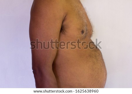 A man showing his epigastric hernia. Abdominal lump. Intestinal hernia. The side view.  Royalty-Free Stock Photo #1625638960
