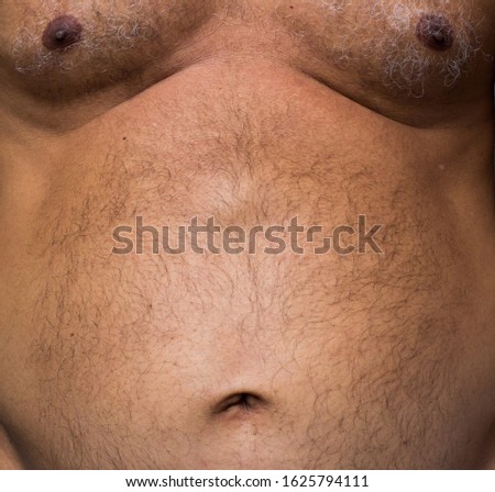 60 year old man showing his epigastric hernia. Abdominal lump. Intestinal hernia. The anatomical position Royalty-Free Stock Photo #1625794111