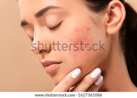 young woman with closed eyes touching face with acne isolated on beige Royalty-Free Stock Photo #1627361086