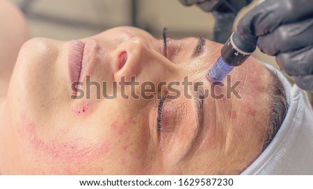 Needle mesotherapy treatment on a woman face.  Royalty-Free Stock Photo #1629587230