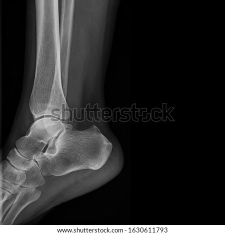 A radiography x-ray film of human foot