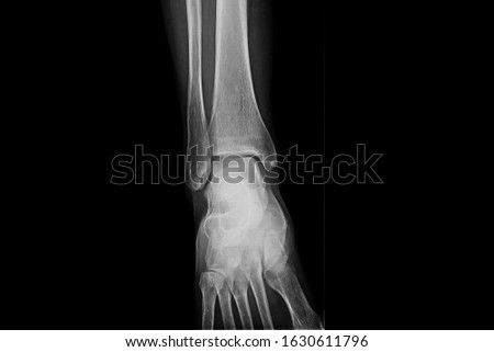 A radiography x-ray film of human foot