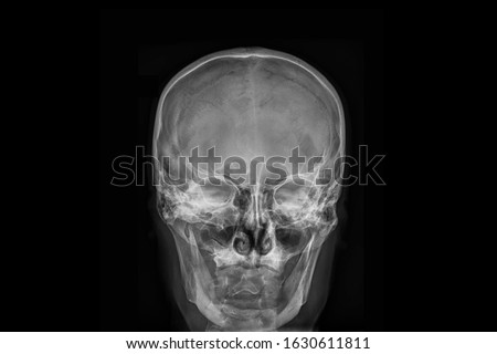 Radiography x-ray film of human skull and paranasal sinuses