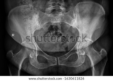Radiography x-ray film of human pelvis and coxofemoral joint