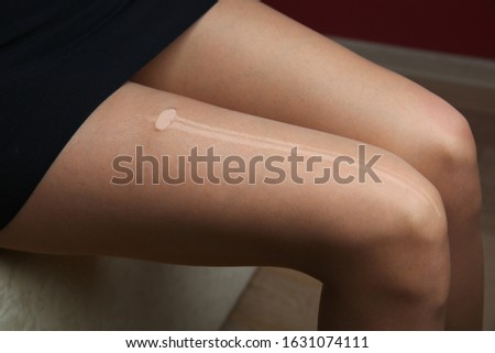 hole in pantyhose on a woman's leg. ripped stockings on a leg