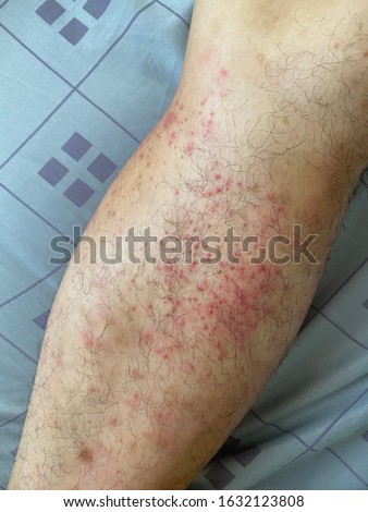 Atopic dermatitis rashes on a man leg.