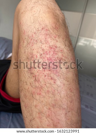 Atopic dermatitis rashes on a man leg.