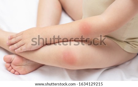 Hands and feet of a young child who has a rash and redness on the skin. The concept of treatment of diseases and skin care in children, background. Dermatology Royalty-Free Stock Photo #1634129215