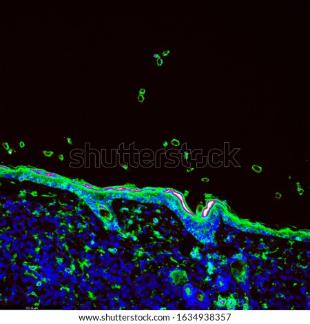 Tumour immunofluorescence IHC image of immunotherapy treatment. Tumor cells in blue attacked by immune system T cells lymphocytes in green Royalty-Free Stock Photo #1634938357