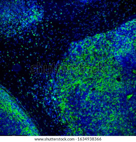Tumour immunofluorescence IHC image of immunotherapy treatment. Tumor cells in blue attacked by immune system T cells lymphocytes in green Royalty-Free Stock Photo #1634938366