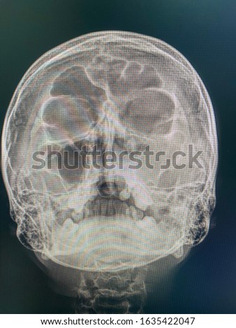 The picture of x-ray sinus view of patient who have sinusitis.