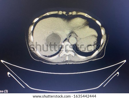The picture of Computerized Tomography Scan of patient who have liver abscess.