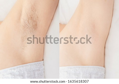 Women underarm hair removal. Concept before and after shaving sugar depilation laser. Royalty-Free Stock Photo #1635618307
