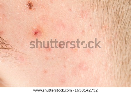 Pimples as a problem in an adolescent teenage boy 13-14 years old