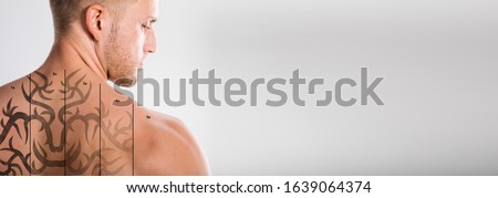 Laser Tattoo Removal On Man's Shoulder Against White Background Royalty-Free Stock Photo #1639064374