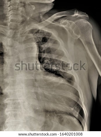 x-ray of the shoulder joint in direct projection