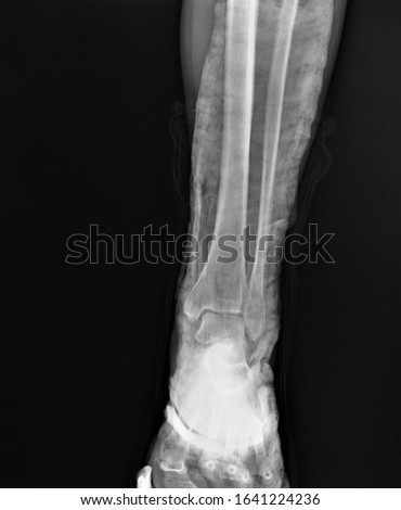 fracture of the lateral ankle on x-ray