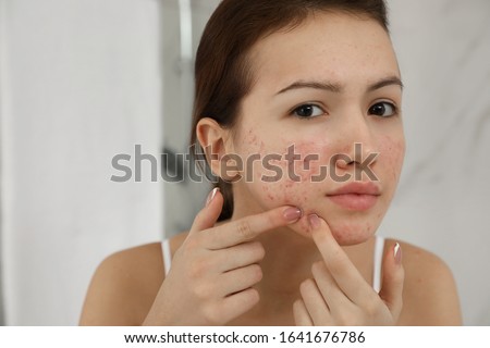 Teen girl with acne problem squeezing pimple indoors Royalty-Free Stock Photo #1641676786