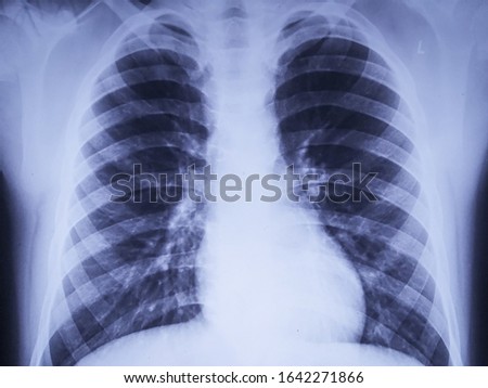 Lung X Ray. RTG image of respiratory system. Chest X-Ray Royalty-Free Stock Photo #1642271866