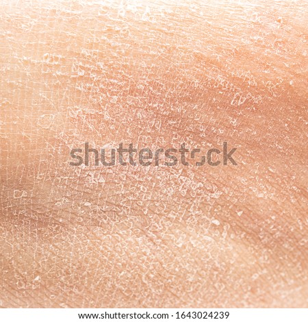 Dry human skin of a woman leg. Concept of skin rehydration cosmetics to keep the skin young Royalty-Free Stock Photo #1643024239