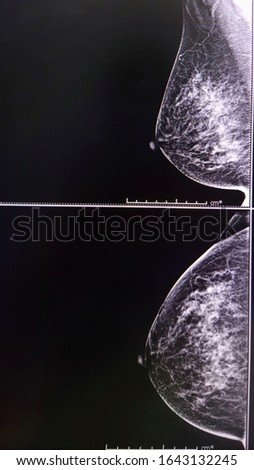 X-ray image of digital mammogram CC and MLO views. Basic of mammography
