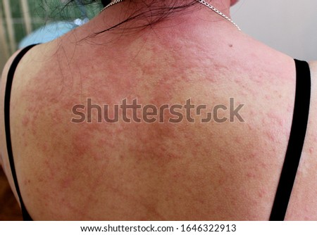 A case of acute urticaria (hives) on the back Royalty-Free Stock Photo #1646322913