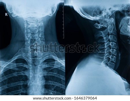 X-ray picture of the cervical spine of a man in two projections in full view and profile