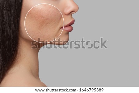 Photo before and after treatment for acne. A young girl with a problem skin. Skin treatments. Cosmetology and professional skin care. Royalty-Free Stock Photo #1646795389