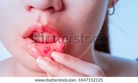 Asian women have aphthous ulcers on mouth on white background, selective focus. Royalty-Free Stock Photo #1647152125