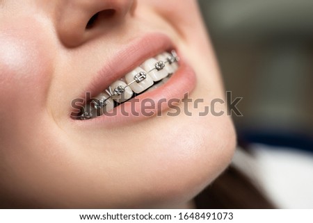 Orthodontic Treatment. Dental Care Concept. Beautiful Woman Healthy Smile close up. Closeup Ceramic and Metal Brackets Royalty-Free Stock Photo #1648491073