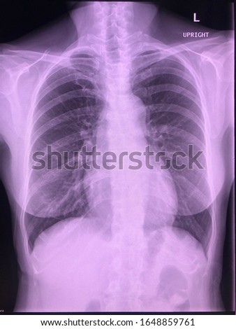 Hight quality chest x-ray image. Digital radiography. Medical background.