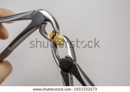 caries-affected destroyed with a large cavity removed human tooth in surgical forceps, molar tooth, wisdom tooth, tooth extraction operation, dental surgery, dental care Royalty-Free Stock Photo #1651332673