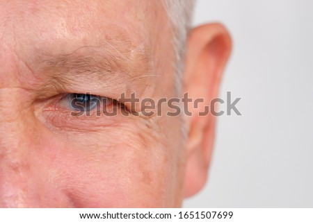 Examination and treatment of patients with cataract and glaucoma eyes. glaucoma concept. Senior man's eye.  Royalty-Free Stock Photo #1651507699