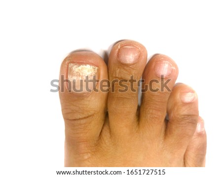 close up picture of onychomycosis of right big toe on the white background Royalty-Free Stock Photo #1651727515