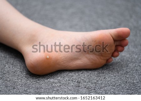 Foot wart, verrucas plantar on the foot of a child from Sweden. A  decease caused by the Human papillomavirus and often spread at communal showers or by sharing socks with others. Royalty-Free Stock Photo #1652163412
