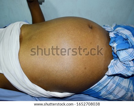 Prominent abdominal distension in Southeast Asian, Myanmar man. Distended abdomen may be due to ascites with cirrhosis, intestinal obstruction or fat. Royalty-Free Stock Photo #1652708038