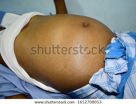 Prominent abdominal distension in Southeast Asian, Myanmar man. Distended abdomen may be due to ascites with cirrhosis, intestinal obstruction or fat. Royalty-Free Stock Photo #1652708053