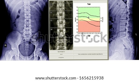 X-ray lumbo-sacral spine and pelvis and inflammation at spine and bone densitometry spine healthcare hospital technology concept. 