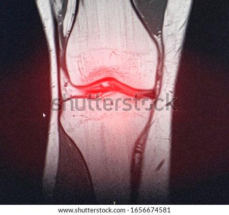 A snapshot of the diagnosis of an MRI of the knee in which arthrosis and arthritis. The concept of joint diagnosis using x-rays, treatment of diseases of the knee joint, bursitis