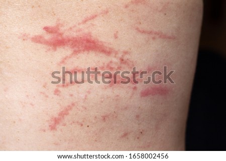 Excoriations on the skin due to scratches due to severe itching Royalty-Free Stock Photo #1658002456