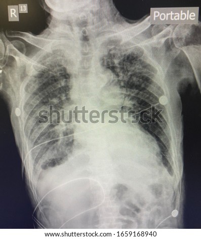 The picture of chest x-ray of patient who have right pleural effusion.Fluid in the lungs. Medical education and diagnostic radiology concept.