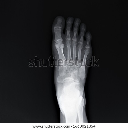 x-ray of the foot, diagnosis of fractures, arthritis, deforming arthrosis