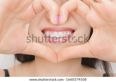 Dental braces in happy womans mouths through the heart. Brackets on the teeth after whitening. Self-ligating brackets with metal ties and gray elastics or rubber bands for perfect smile. Orthodontic Royalty-Free Stock Photo #1660374508