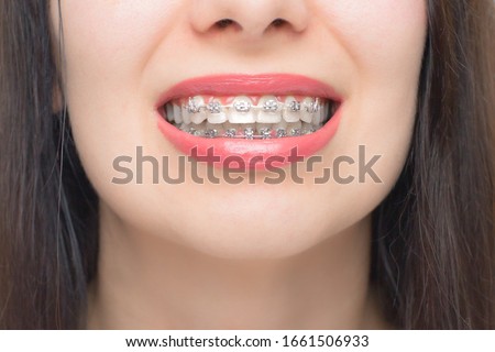 Young woman smile with dental braces. Brackets on the teeth after whitening. Self-ligating brackets with metal ties and gray elastics or rubber bands. Orthodontic teeth treatment Royalty-Free Stock Photo #1661506933