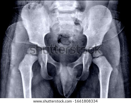 Frontal x-ray bones of a child's pelvis Royalty-Free Stock Photo #1661808334
