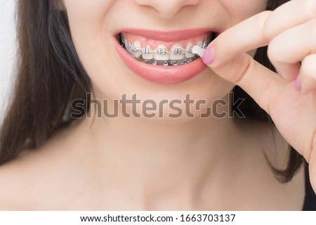 Applying orthodoentic wax on the dental braces. Brackets on the teeth after whitening. Self-ligating brackets with metal ties and gray elastics or rubber bands for perfect smile. Royalty-Free Stock Photo #1663703137